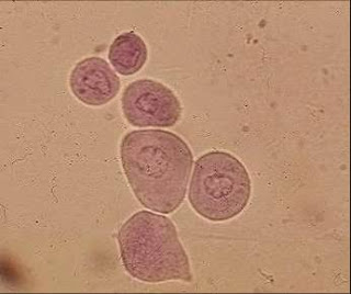 Image result for round cells found in the bladder (http://2.bp.blogspot.com/_8rVKFil-ZlI/SW1-p9ujgKI/AAAAAAAABl0/HViIvqGgXmM/s320/Picture17.jpg)