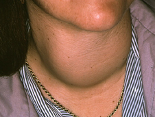 woman's neck swelling due to thyrotoxic goitre (http://www.bbc.co.uk/staticarchive/fd67b6ee375548fc51cfa92dbceca30cafec5216.jpg)