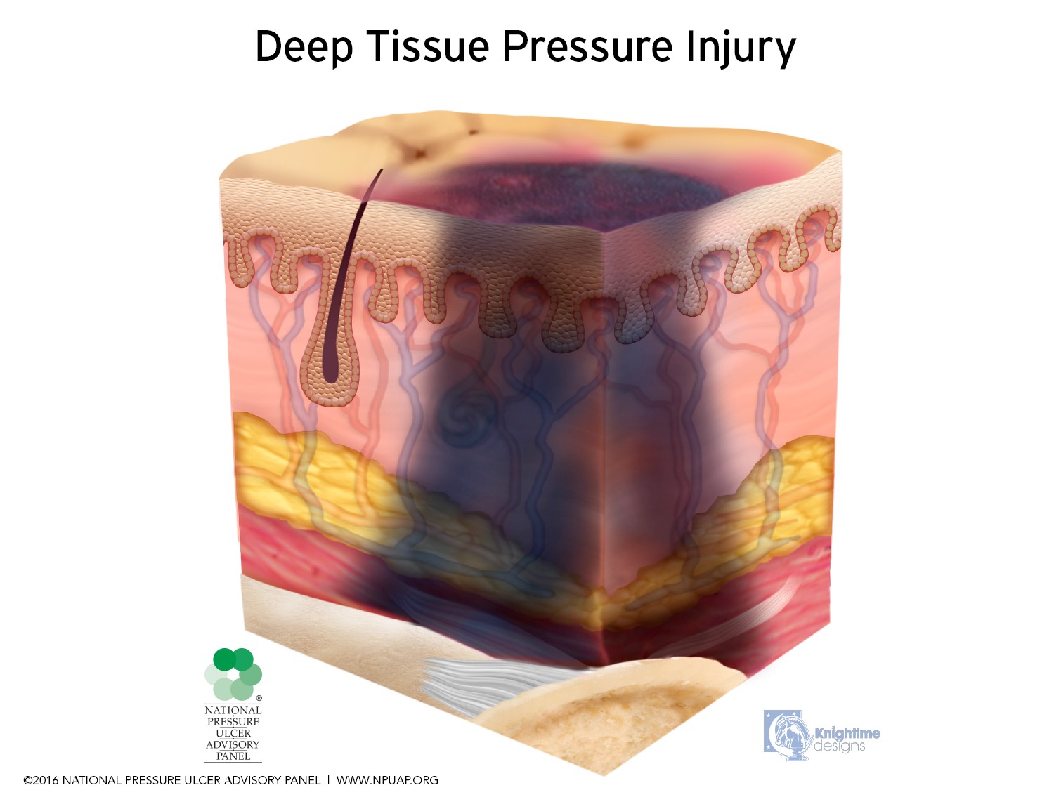 (http://woundeducators.com/wp-content/uploads/2017/09/Deep-Tissue-Pressure-Injury-April-2016.jpg)