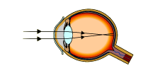 the focus is in front of the retina (http://www.bbc.co.uk/schools/gcsebitesize/science/images/sight_myopia.gif)
