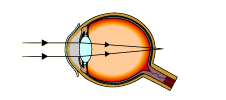 The focus is behind the retina (http://www.bbc.co.uk/schools/gcsebitesize/science/images/sight_hypermetropia.gif)