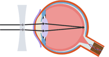 A concave lens corrects short-sightedness, allowing the image to focus on the retina (http://www.bbc.co.uk/staticarchive/5ef8885a6aa102eec56db48d3228db488a00f1b4.gif)
