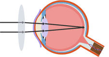 A convex lens corrects long-sightedness, allowing an image to focus on the retina (http://www.bbc.co.uk/staticarchive/fbf784057fdb35432f5e8982766fa95b04ce7fc1.gif)