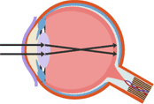 If the distance between a lens and a retina is too great it causes short-sightedness (Myopia) (http://www.bbc.co.uk/schools/gcsebitesize/science/images/triple_science/045_bitesize_gcse_tsphysics_medical_sight3_table.gif)