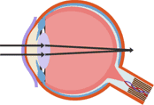 An image passing through an eye lens and focusing behind the retina equates to long-sightedness (Hypermetropia) (http://www.bbc.co.uk/schools/gcsebitesize/science/images/triple_science/042_bitesize_gcse_tsphysics_medical_sight1_table.gif)