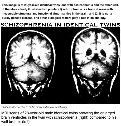 (http://palmreadingperspectives.files.wordpress.com/2011/06/schizophrenia-brains-identical-twins.jpg)