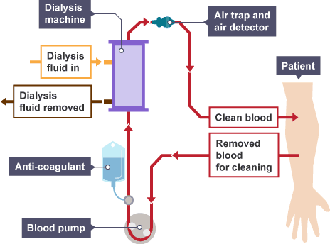 Kidney dialysis the process by which toxic compounds from the blood are removed. (http://www.bbc.co.uk/schools/gcsebitesize/science/images/triple_science/015_bitesize_gcse_tsbiology_removalofwasteandwatercontrol_insideadialysismachine_464.gif)